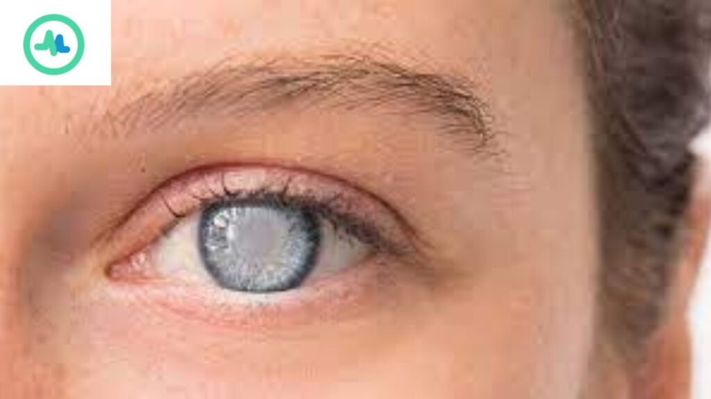 gambar penyakit mata glaukoma