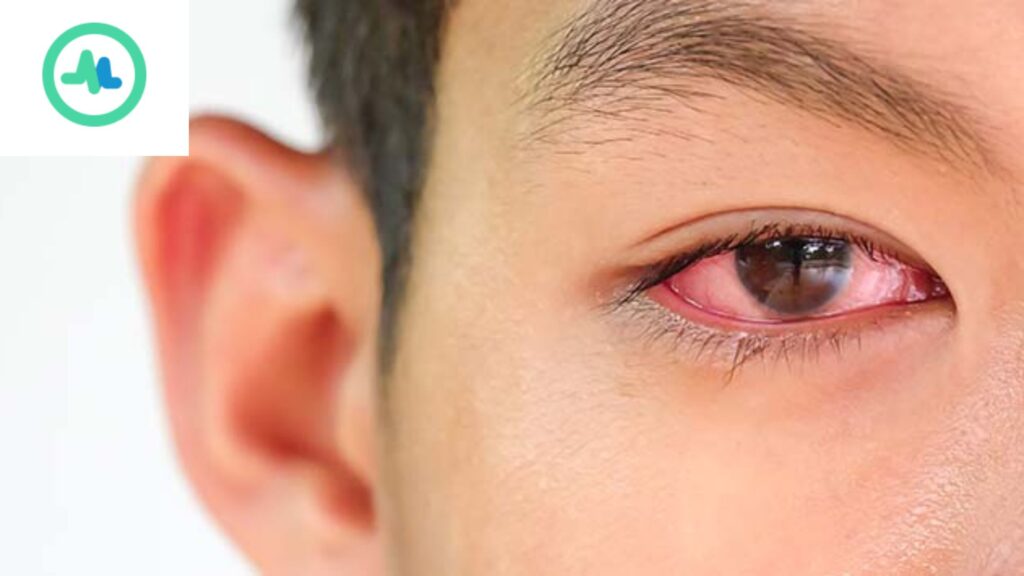 gambar penyakit mata Konjungtivitis